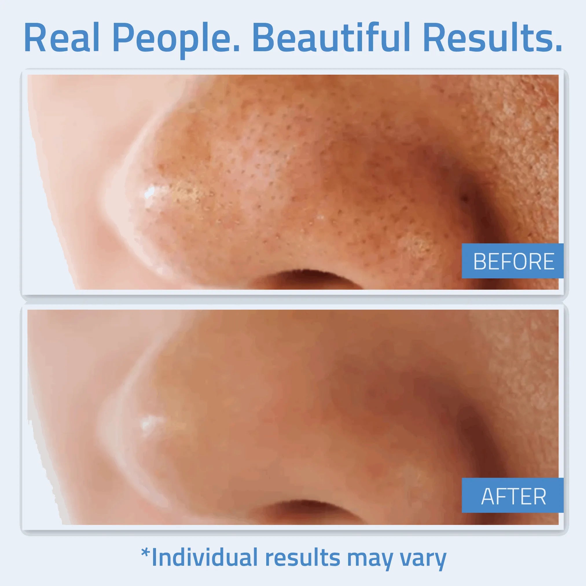 Salicylic Acid Gel Peel 1 oz Salicylic Acid Gel Peel 1 oz Salicylic Acid Gel Peel 1 oz