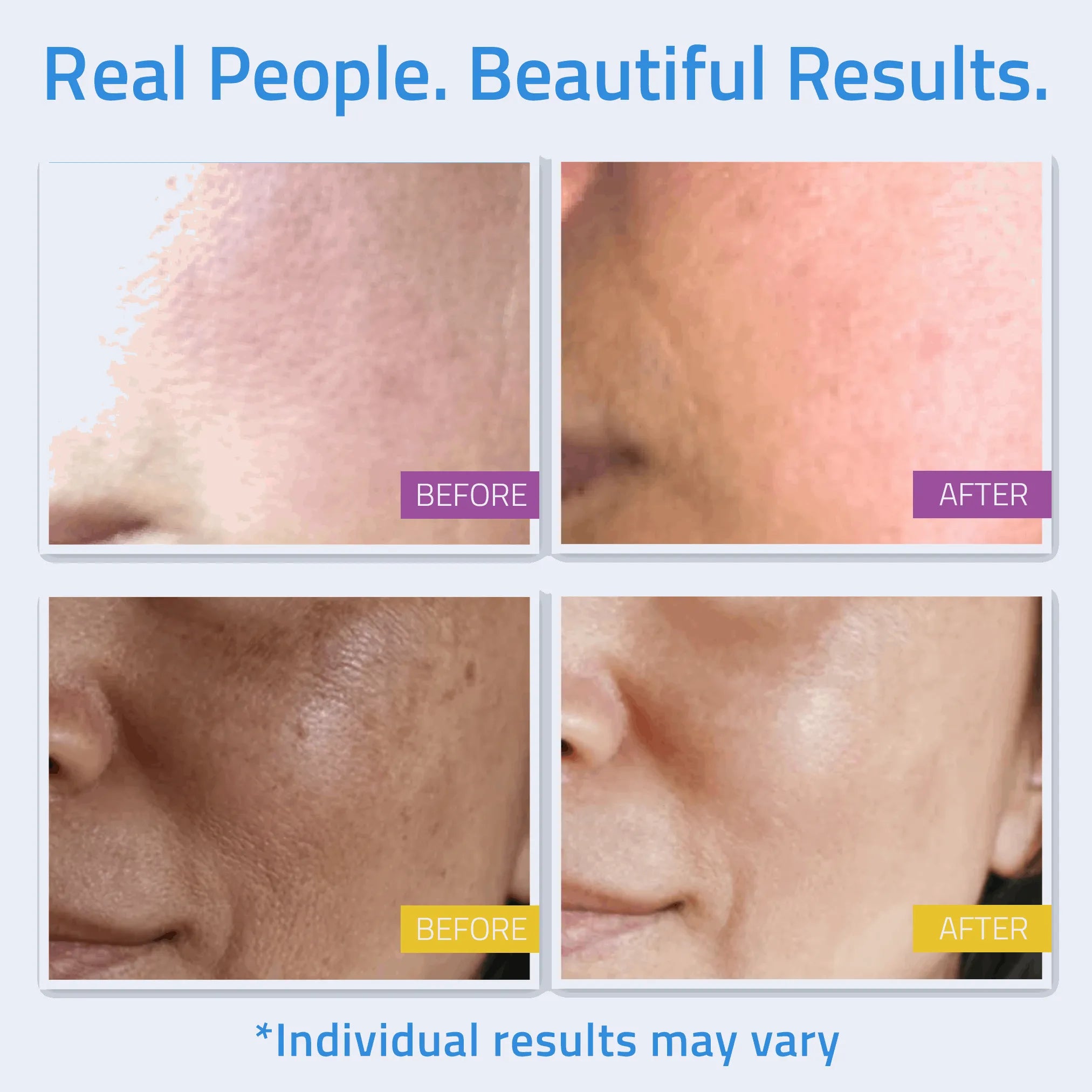 Complete Skincare Essentials Set (8 Pack) Before and after comparison showing visible skin texture and tone improvement from products in the skincare kit.