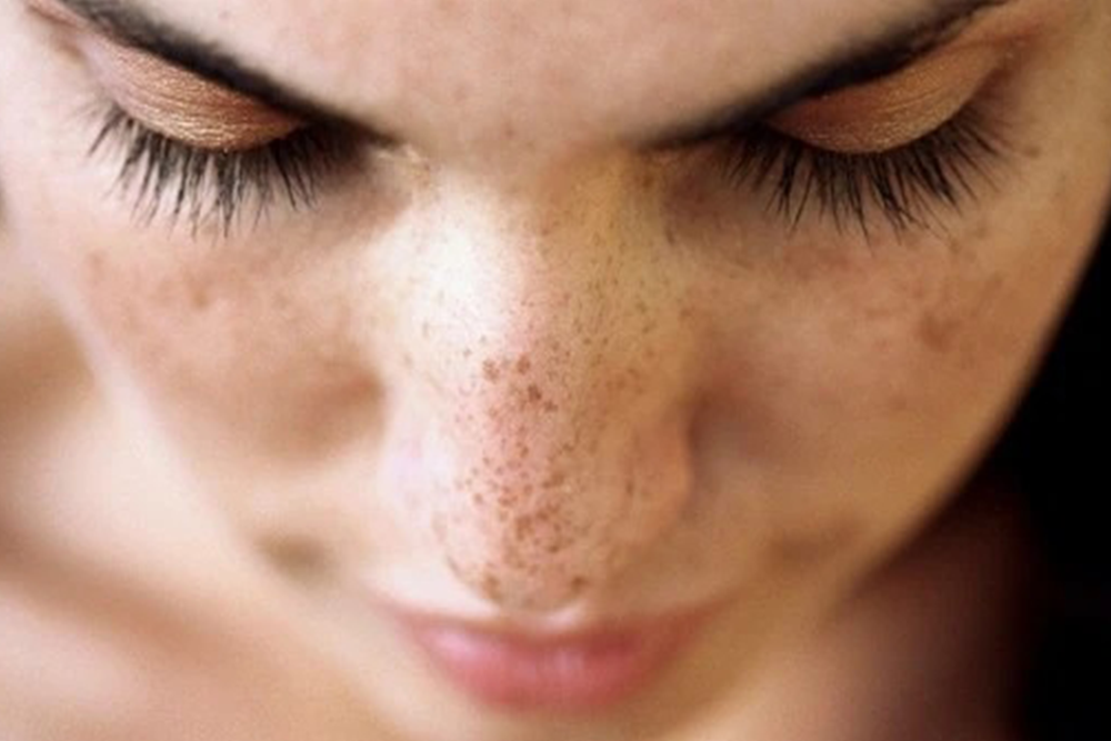 Hyperpigmentation: Causes & Treatments