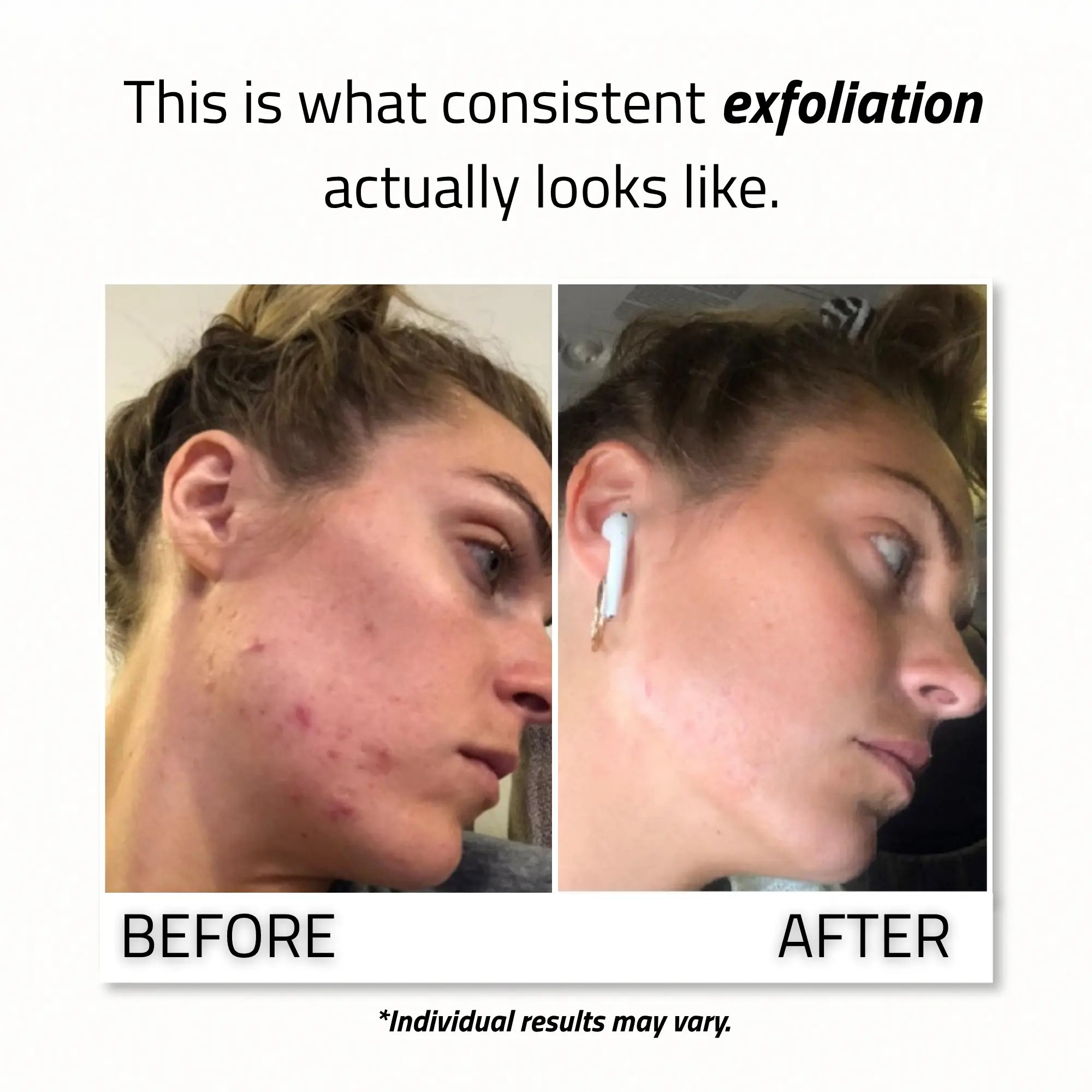 Glycolic Acid Gel Peel 30%