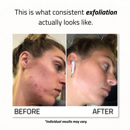 Glycolic Acid Gel Peel 30%