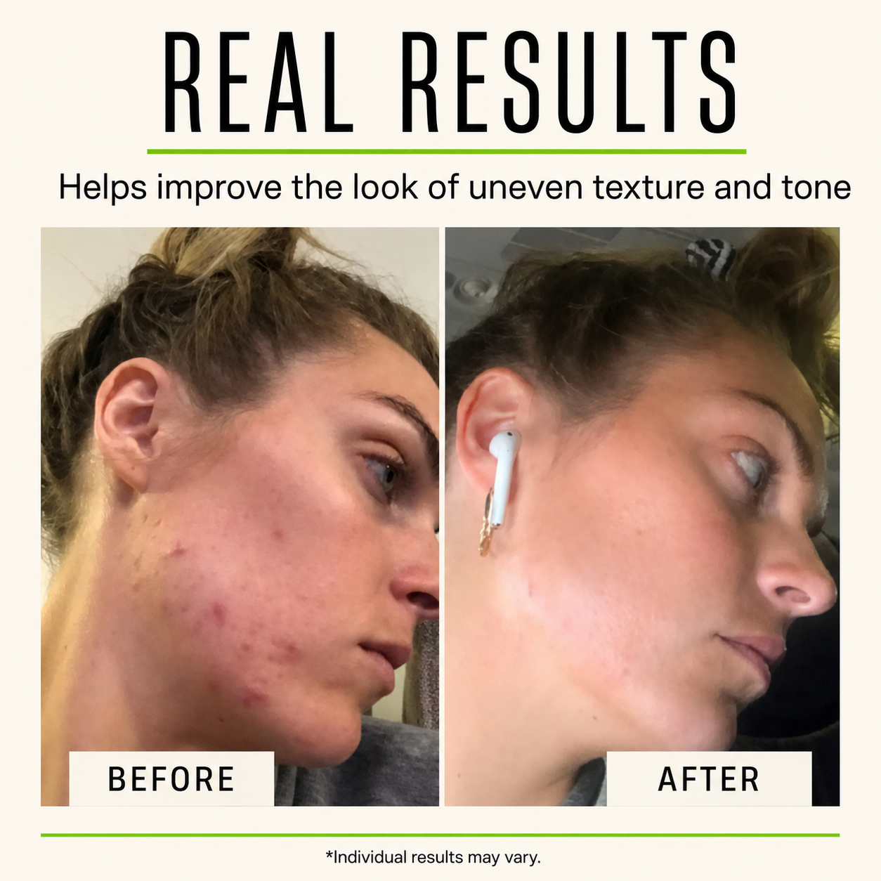 Glycolic Acid Gel Peel 30%