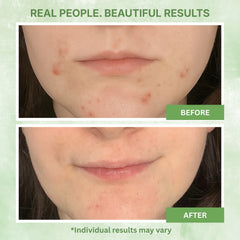 Glycolic Acid Gel Peel 30% 