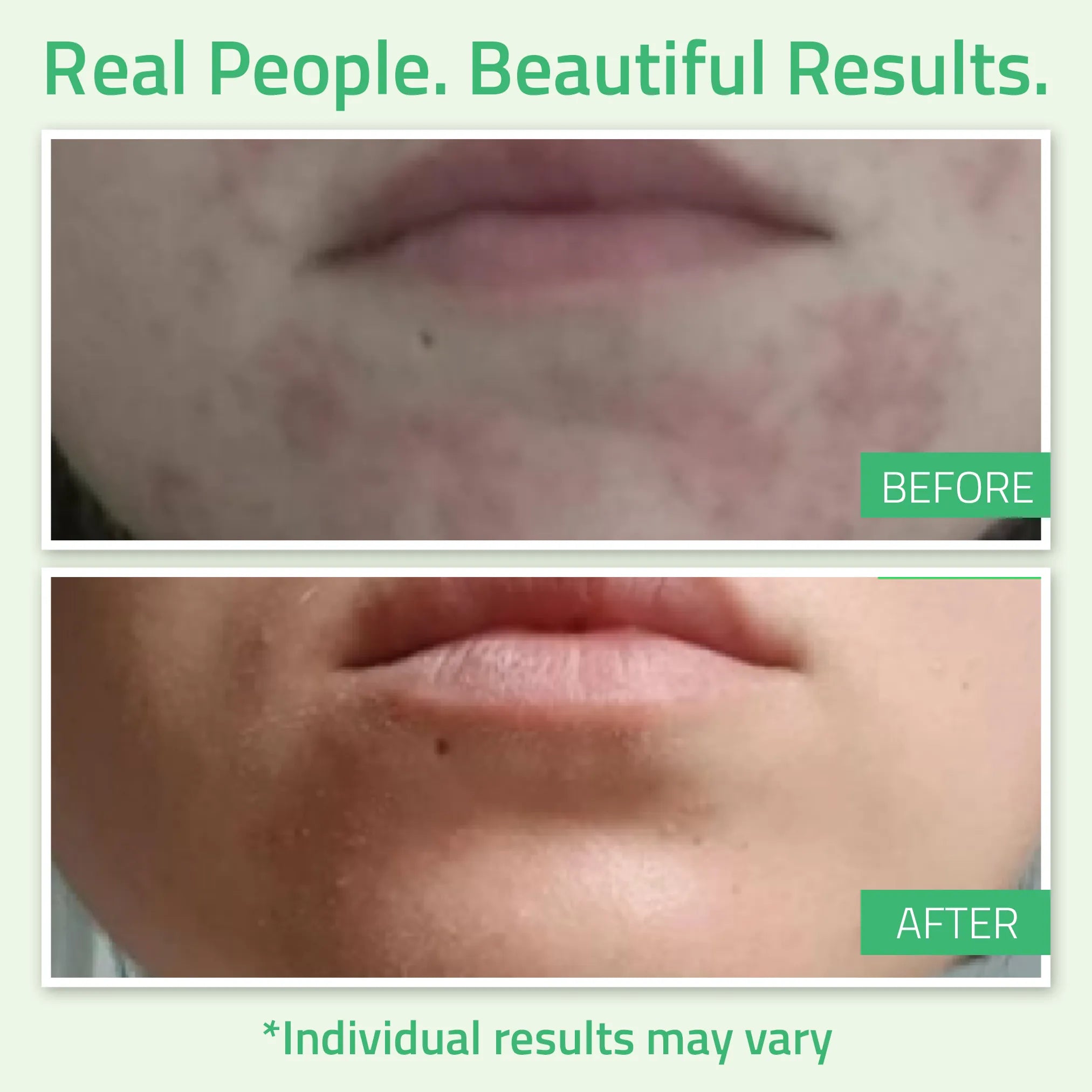 Glycolic Acid Gel Peel 30% Glycolic Acid Gel Peel 30%