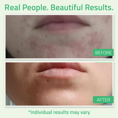 Glycolic Acid Gel Peel