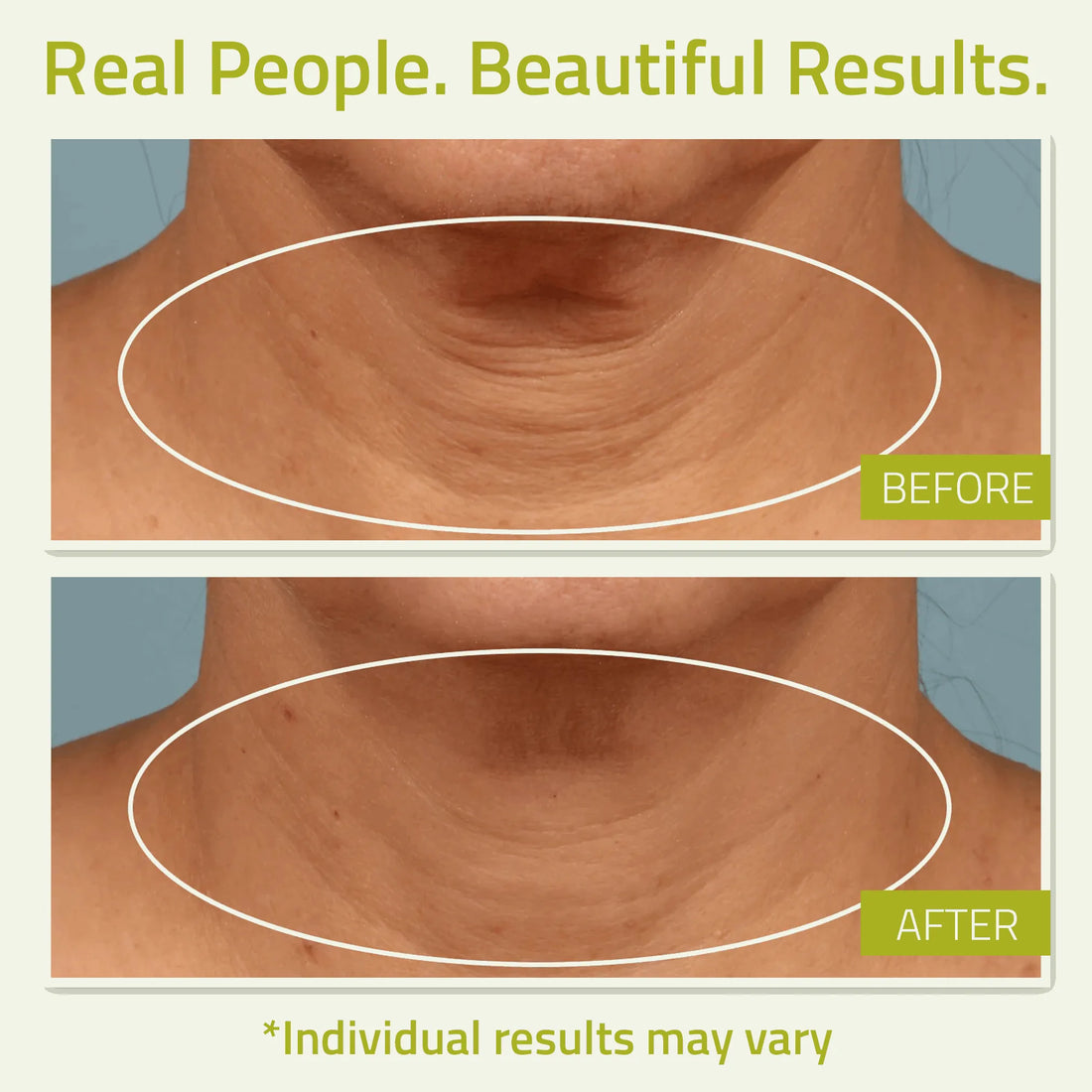 Neck Firming Cream with Green Tea and Vitamin C Before and after comparison of a neck showing visible improvement in skin smoothness after using a neck tightening cream.