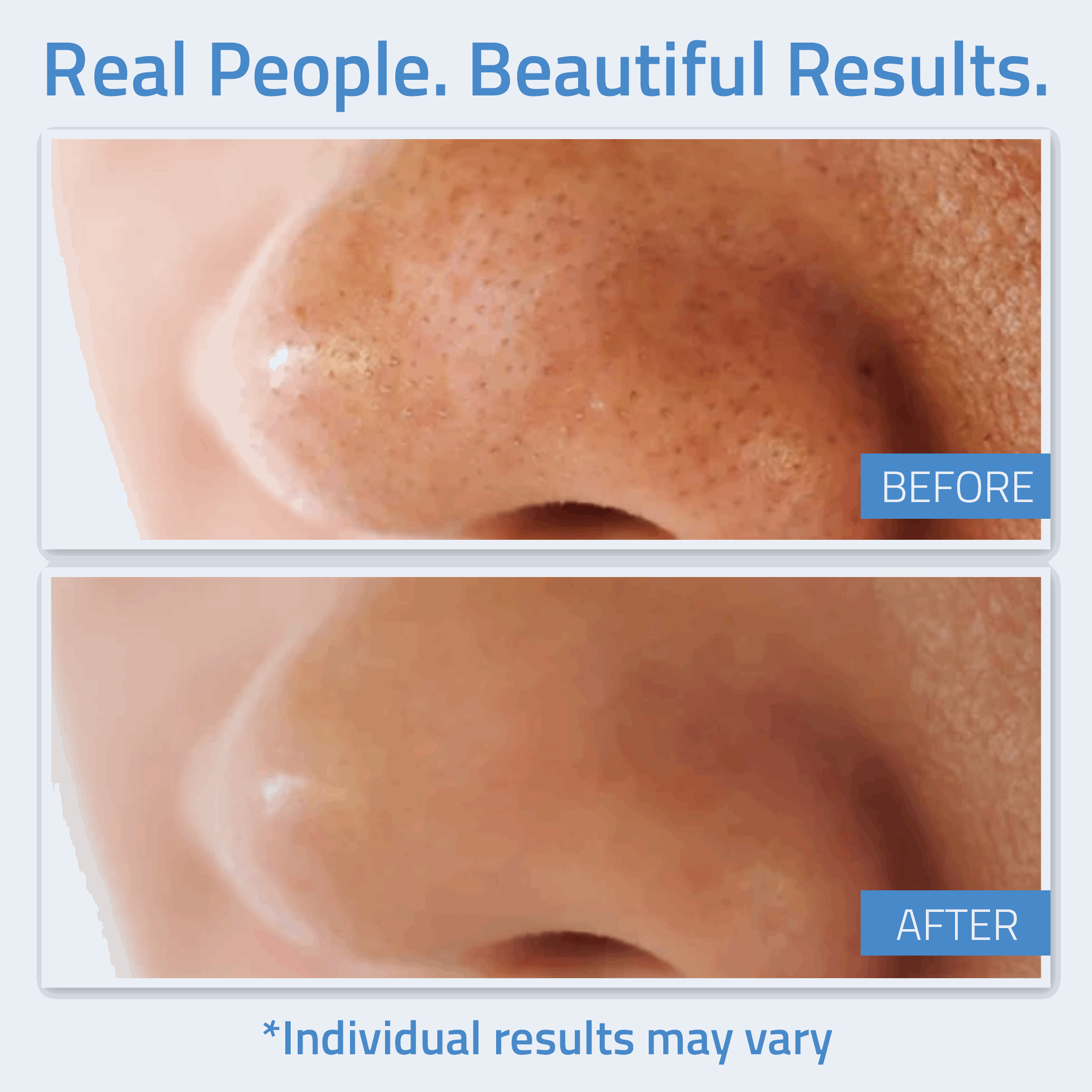 Salicylic Acid Gel Peel 1 oz Salicylic Acid Gel Peel 1 oz