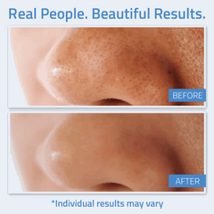 Salicylic Acid Gel Peel 1 oz