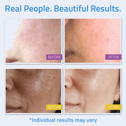 Complete Skincare Essentials Set (8 Pack) Before and after comparison showing visible skin texture and tone improvement from products in the skincare kit.