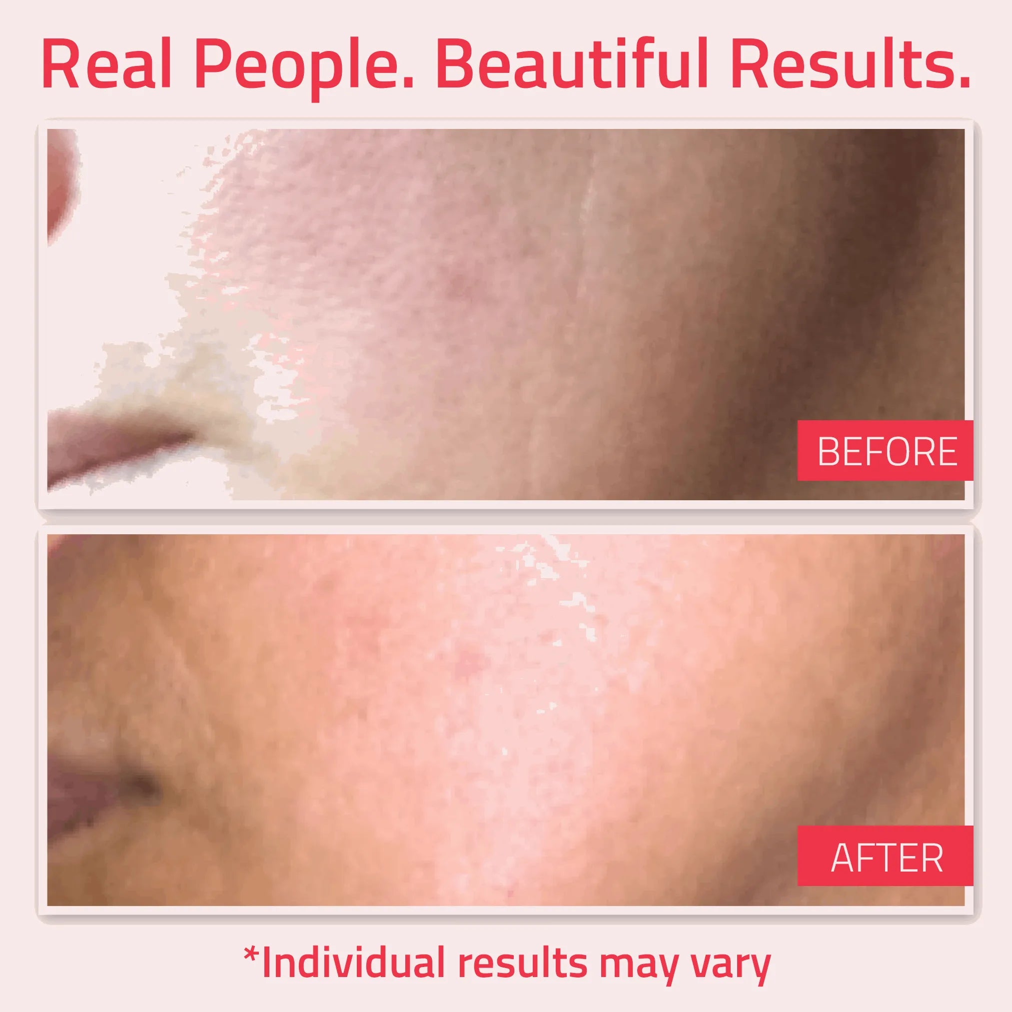 Retinol Moisturizer Before-and-after of cheek showing smoother skin after using YEOUTH best retinol cream, with disclaimer shown.