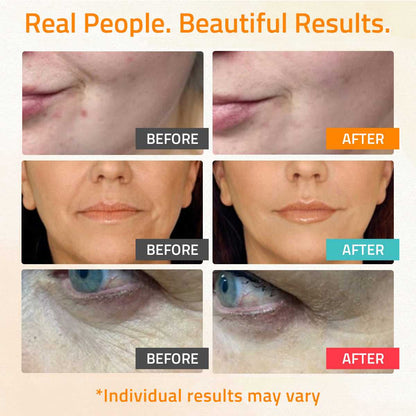 Before and after images showing visible skin improvement after using YEOUTH serum gift set.